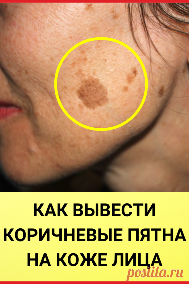 КАК ВЫВЕСТИ КОРИЧНЕВЫЕ ПЯТНА НА КОЖЕ ЛИЦА