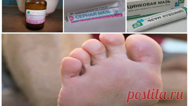 Лечение грибка цинковой мазью: Дешево, но эффективно! — Полезные советы