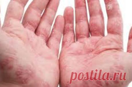 Чем лечить псориаз на руках