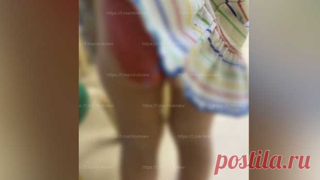 В регионе девочка попала в больницу с сильным ожогом после дня в детсаду. В Татарстане ребенок получил крупный ожог второй степени. Об этом сообщает прокуратура региона. По словам матери девочки, утром ее муж привез дочь в детский сад. Спустя некоторое время воспитательница позвонила родительнице и сообщила об ...