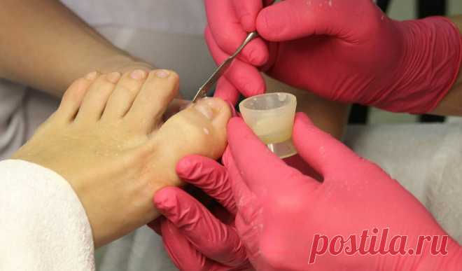 Мастер отказалась делать мне педикюр в салоне из-за грибка ногтей, но дала полезный совет, который помог решить проблему | ЗОЖ и Галка | Яндекс Дзен
