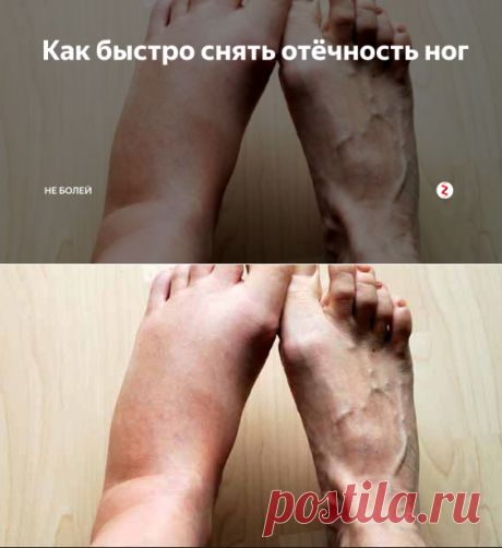 Как быстро снять отёчность ног | Не Болей | Яндекс Дзен