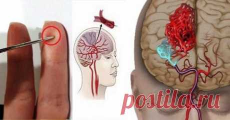 Как простая игла может спасти вам жизнь в случае инсульта? / Будьте здоровы