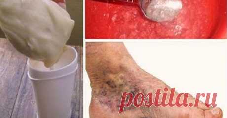 Попробуй это волшебное средство при варикозе и тромбозе! Только 2 простых ингредиента. Смотри видео! В этой статье мы представляем вам чудесный и естественный домашний рецепт для лечения этой проблемы. В настоящее время проблема с варикозным расширением