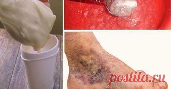 Попробуй это волшебное средство при варикозе и тромбозе! Только 2 простых ингредиента. Смотри видео! В этой статье мы представляем вам чудесный и естественный домашний рецепт для лечения этой проблемы. В настоящее время проблема с варикозным расширением