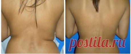 Коррекция фигуры с помощью мезотерапии
Коррекция фигуры сейчас очень востребована и мезотерапия приходит на помощь в этом, как она проводится, эффект мезотерапии и противопоказания к процедуре