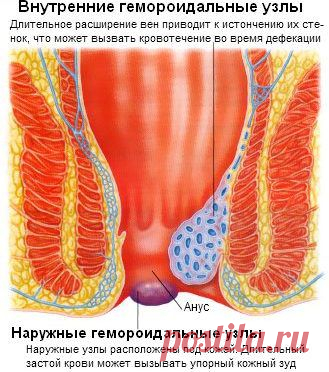 Геморроидальные узлы тромбоз геморроидального узла