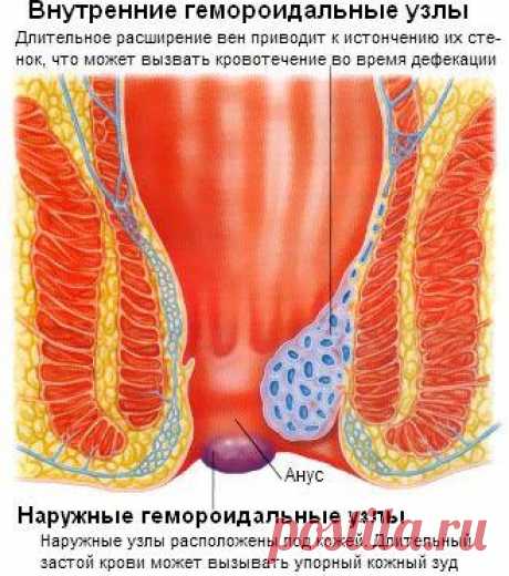Геморроидальные узлы тромбоз геморроидального узла