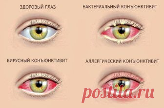 Коньюктивит: эффективное лечение натуральными средствами