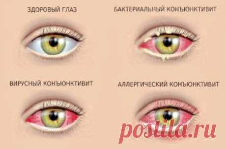 Коньюктивит: эффективное лечение натуральными средствами