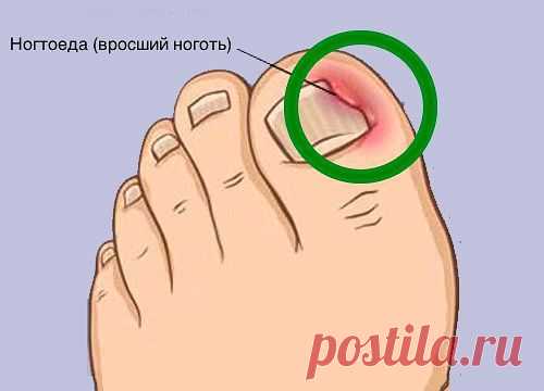 Проблема вросшего ногтя