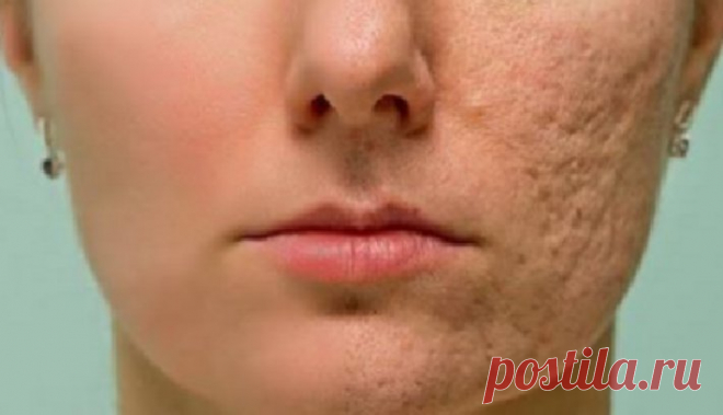 Все мечтают о светлой и чистой коже. Существует множество продуктов и методов лечения, которые часто не работают. Тем не менее, вместо этого, вы можете улучшить состояние кожи легкой естественной смесью, которая может устранить морщины, пятна и шрамы с вашего лица. Основным компонентом этого средства является мед, который улучшить состояние кожи, кроме различных других преимуществ для […]