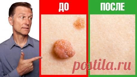 Как избавиться от бородавок и папиллом за 1 день💥 Курс ДИАГНОСТИКА ЗДОРОВЬЯ ПО КОЖЕ 👉 https://drberg.ru/diagnosis-kСКАЧАТЬ БЕСПЛАТНО материалы Доктора Берга ➡️ https://online.drberg.ru/freeКак избавиться от...