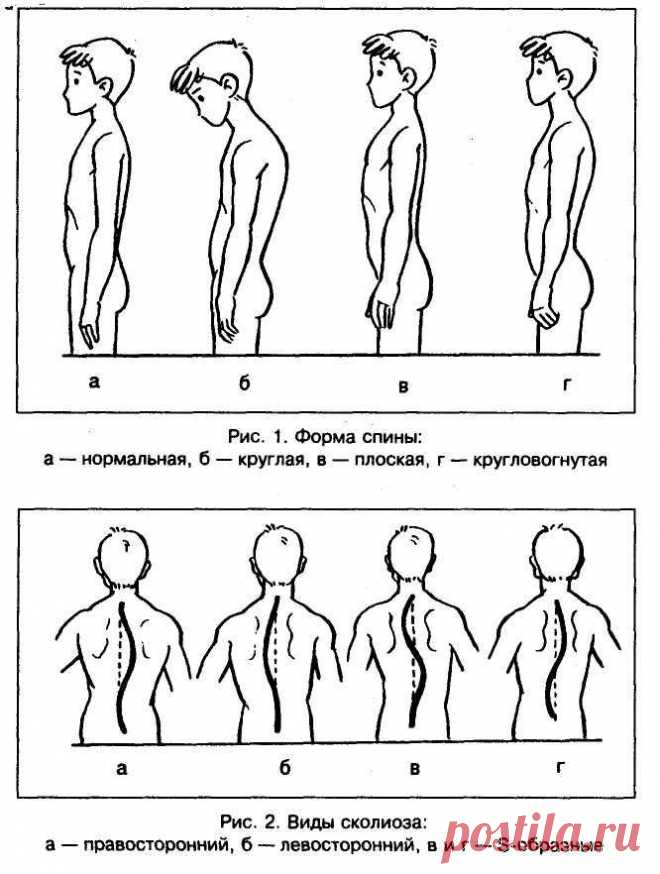 Нарушение осанки у детей: причины, профилактика, лечение и упражнения