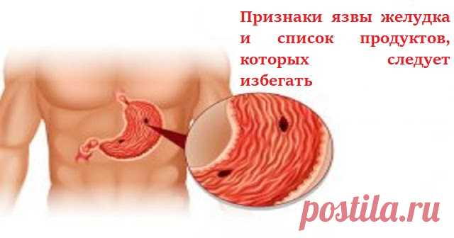 Признаки язвы желудка и список основных продуктов, которых следует избегать! Не игнорируйте! Язва желудка или язв двенадцатиперстной кишки — это перелом в подкладке желудка или в первой части тонкого кишечника (или, иногда, нижнего