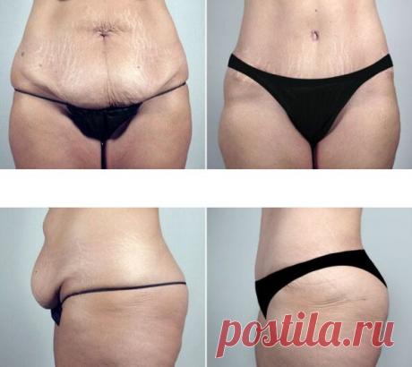 Как убрать возрастной жир на животе и дряблую кожу при помощи домашнего средства за 15 дней

Как убрать возрастной жир на животе и избавиться от дряблой кожи, используя домашние средства за 15 дней

Мне 40 лет. Всю жизнь я была склонна к полноте, но занимаясь в тренажёрном зале и придерживаясь правильного питания, мне удавалось держать вес на одном уровне. Но после рождения ребёнка, я не смогла прийти в форму, постоянно хотелось есть и