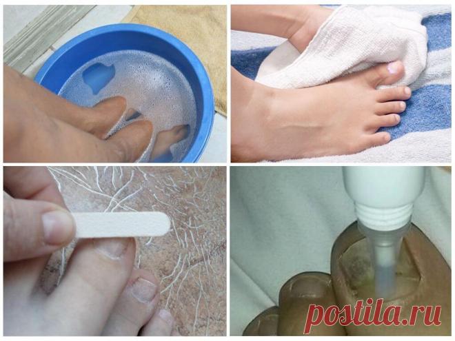 Микозан от грибка ногтей – отзывы, цена, инструкция по применению, аналоги