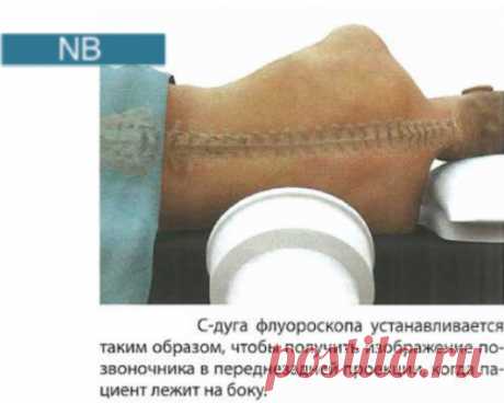 Интратекальная терапия с помощью программируемых помп: методика, порядок выполнения | Врач травматолог-ортопед, онлайн кабинет