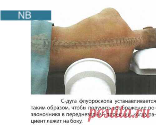 Интратекальная терапия с помощью программируемых помп: методика, порядок выполнения | Врач травматолог-ортопед, онлайн кабинет