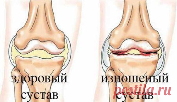 боли в суставах