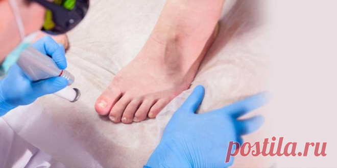 Грибок ногтей: экспертное мнение специалистов Sensavi