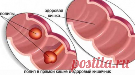 Что такое полипы в кишечнике... Что такое полипы в кишечнике? Это доброкачественные новообразования, образующиеся из железистого эпителия и имеющие широкое основание или ножку. Заболевание в основном протекает бессимптомно. Признаки появляются при увеличении объема полипов...