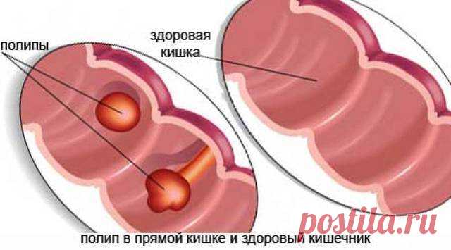 Что такое полипы в кишечнике... Что такое полипы в кишечнике? Это доброкачественные новообразования, образующиеся из железистого эпителия и имеющие широкое основание или ножку. Заболевание в основном протекает бессимптомно. Признаки появляются при увеличении объема полипов...