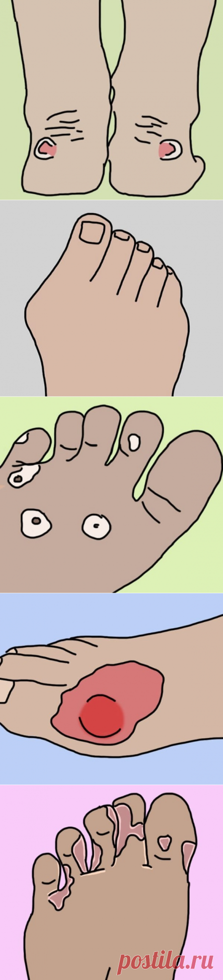 Простые решения неприятных болезней ног