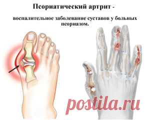 Псориатический артрит - симптомы и фото. Псориатический артрит без псориаза