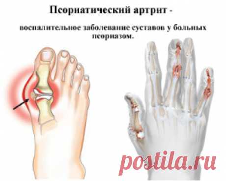 Псориатический артрит - симптомы и фото. Псориатический артрит без псориаза