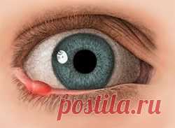 Как быстро избавиться от ячменя..