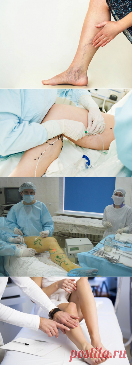 Рекомендации после флебэктомии [#восстановление] Профилактика осложнений