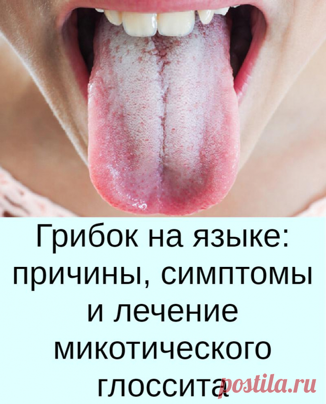 Грибок на языке: причины, симптомы и лечение микотического глоссита