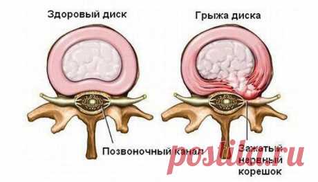 Я 5 лет мучилась от грыжи межпозвоночного диска, пока не попробовала эти способы! Так хорошо я себя давно не чувствовала!