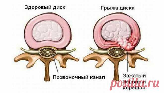 Я 5 лет мучилась от грыжи межпозвоночного диска, пока не попробовала эти способы! Так хорошо я себя давно не чувствовала!