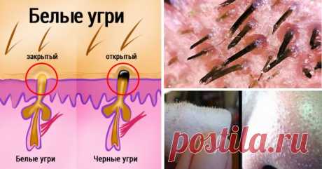 Больше никаких мучительных походов к косметологу! Хитрый трюк для избавления от черных точек 

 
Черные точки, или угри, появляются в связи с накоплением в порах избыточного кожного сала или мертвых клеток кожи. Грязь не является основной причиной возникновения угрей, следовательно, ежедневно…