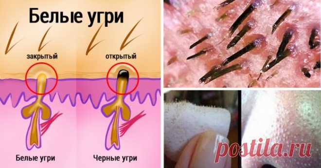 Больше никаких мучительных походов к косметологу! Хитрый трюк для избавления от черных точек 

 
Черные точки, или угри, появляются в связи с накоплением в порах избыточного кожного сала или мертвых клеток кожи. Грязь не является основной причиной возникновения угрей, следовательно, ежедневно…