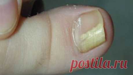 Это простое 2-компонентное средство навсегда избавит от грибка ногтей! Пожелтение и отслаивание ногтевой пластины, появление трещинок и зуд между пальцами — симптомы грибковой инфекции. Статистика свидетельствует, что каждый 5-й житель Земли страдает от этой проблемы.