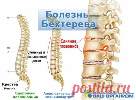 Болезнь Бехтерева: причины, симптомы, диагностика, лечение Что такое болезнь Бехтерева (анкилозирующий спондилоартрит), подробное описание, причины возникновения, классификация, симптомы, методы диагностики и лечения.