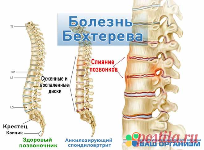 Болезнь Бехтерева: причины, симптомы, диагностика, лечение Что такое болезнь Бехтерева (анкилозирующий спондилоартрит), подробное описание, причины возникновения, классификация, симптомы, методы диагностики и лечения.
