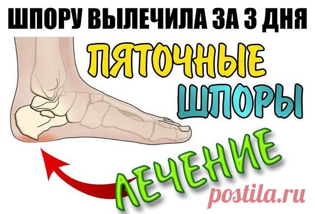 ШПОРУ ВЫЛЕЧИЛА ЗА 3 ДНЯ Поделюсь рецептами от пяточных шпор. Прошлым летом на юге после ванн у меня так разболелась нога, что я не знала, куда ее деть. Пятка горела огнем.
