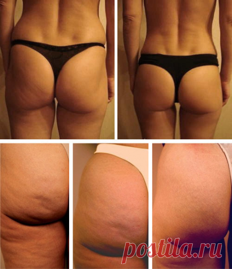 Использую простые советы, я избавилась от целлюлита, жира на животе и похудела на 12 килограмм. Срок 1,5 месяца! | Подслушано у диетолога | Яндекс Дзен