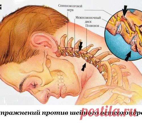 Восемь упражнений против шейного остеохондроза