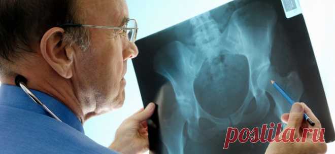 Остеопороз. Лечение гомеопатией..
