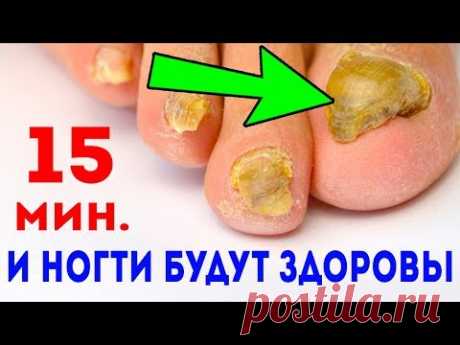15 мин. ГРИБОК НОГТЕЙ - как ветром сдует. Лечение грибка ногтей