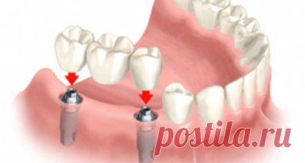 Зубные протезы