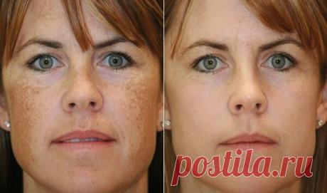 Аптечная мазь за 80 рублей от пигментации, которая действительно работает | Экономлю, коплю, трачу. | Яндекс Дзен