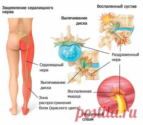Упражнения при ишиасе седалищного нерва: ЛФК и лечебная гимнастика. Лечение медикаментами ишиаса за 2 дня когда острая боль