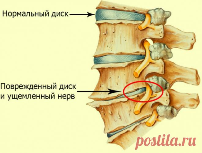 Если смешаешь немного соли с оливковым маслом, забудешь о боли лет на 5! 


Загрузка…



Остеохондроз — распространенное заболевание, при котором возникает дистрофия ткани межпозвоночных дисков, в результате чего позвоночник теряет свойственную ему гибкость.
Спровоцировать…