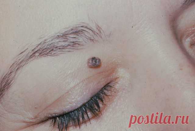 Вот как избавиться от бородавок, чёрных точек, родинок и папиллом. Без лазеров, врачей и операций!
Многие люди страдают от разных неприятных образований на коже. Особенно они раздражают на лице.

Вот как быстро и просто избавиться от них с помощью натуральных домашних средств:

1. Бородавки.

Яблочный уксус.
Яблочный уксус широко известен своими противовоспалительными свойствами, что и делает его эффективным в борьбе с вирусами (а именно они вызывают бородавки). Промойте п...